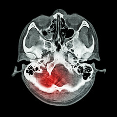 Brain injury, Stroke : ( CT scan of brain and base of skull ) ( Bone window )