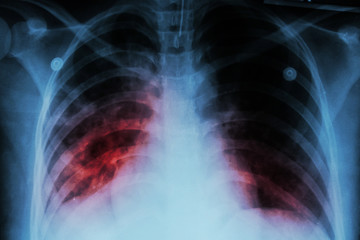 Pulmonary Tuberculosis ( TB )  :  Chest x-ray show alveolar infiltration at both lung due to...