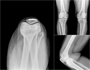collection of xray of normal a human knee