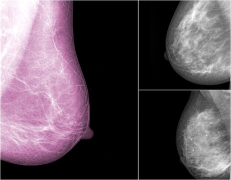 collection of Mammogram radio imaging for breast cancer