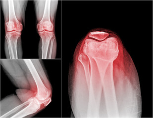 collection of xray of normal a human knee , painful