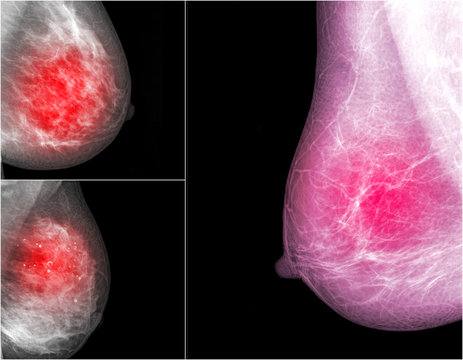 collection of Mammogram radio imaging for breast cancer