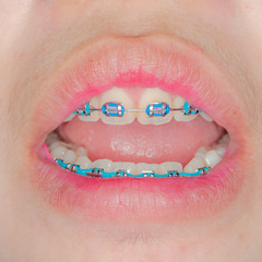 Closeup on braces and white teeth of smiling girl