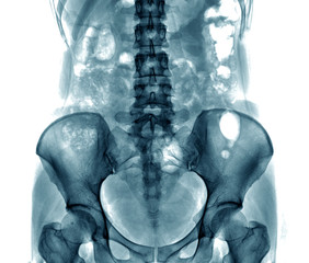 spine and pelvis of a human body on x-ray