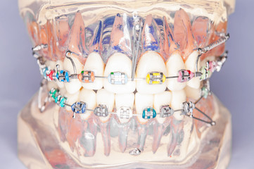 Braces model with miniscrew