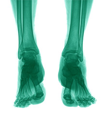 medical copy of two soles ,front view