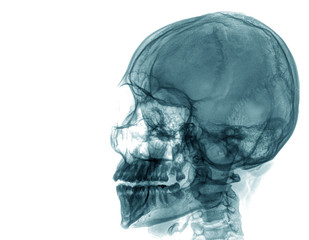 X-ray of a human skull