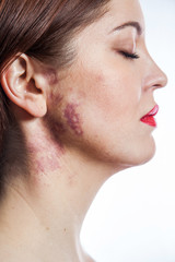 beautiful woman with port-wine stain (birthmark) on her face.
