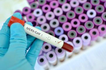 Obraz premium Blood sample with MERS-CoV (Middle East respiratory syndrome coronavirus) positive
