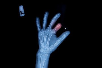 Obraz premium X-ray of trauma hand and finger