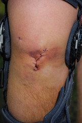 Knie Kreuzbandriss Operation OP Knieorthese 