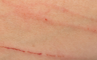 scratches on the skin