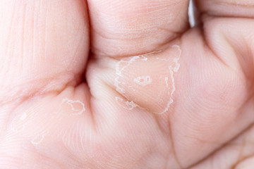Close up peeling on hand