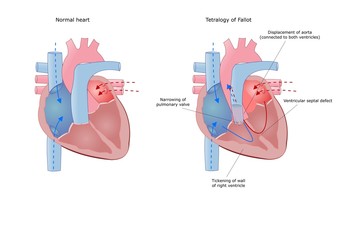 tetralogia di Fallot, malformazione cardiaca - obrazy, fototapety, plakaty