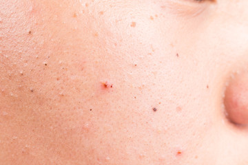 Teenager with acne, pimples and black heads on his face 