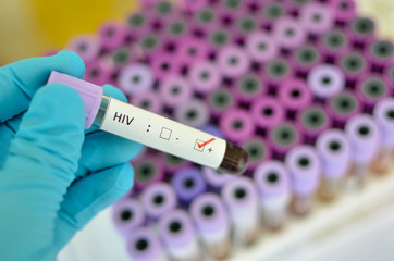 Blood sample with HIV positive - obrazy, fototapety, plakaty