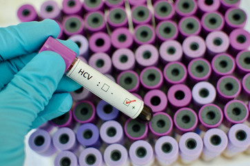 Fototapeta premium Hepatitis C virus positive