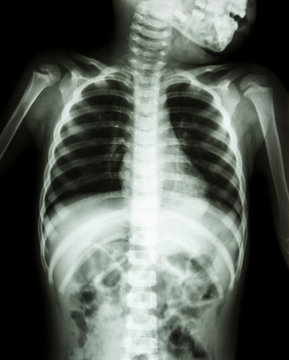 Chest X-ray of child show neck , thorax , shoulder , arm , abdomen