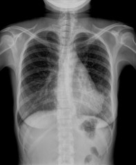 x-ray of chest