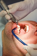 close-up of whitening teeth by dental hygienist