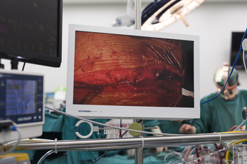 behind monitor at heart bypass machine station