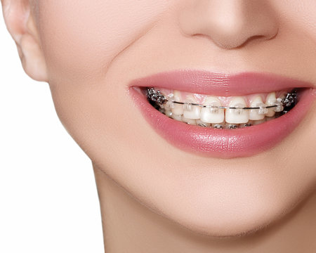 Teeth with Braces, Dental Care concept, front view. 