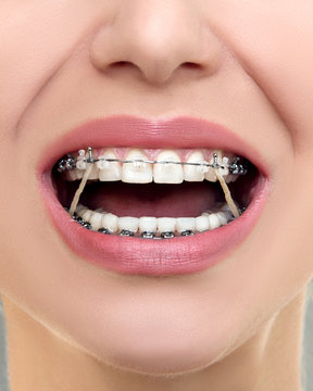 Closeup Ceramic and Metal Braces on Teeth with Elastic Rubber Bands. Open Female Mouth with Self-ligating Braces. Orthodontic Treatment.
