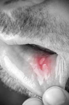 Man shows his lower lip with aphtha