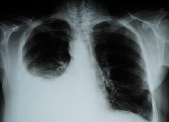 X-ray image of Human Chest