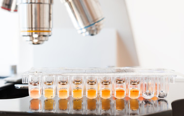 Positive urine test for candida fungus on laboratory microscope