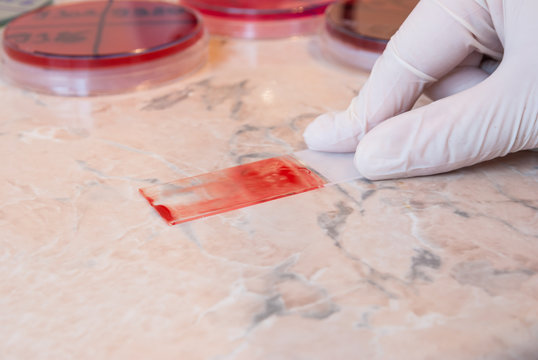 Laboratory doctor hand holding blood smear test or blood film