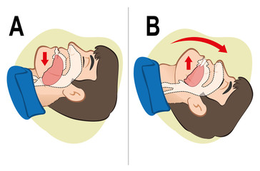 First Aid resuscitation (CPR), clearing breathing, positioning.