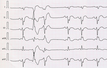 ECG with myocardial infarction and pair ventricular beats