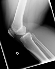 X-ray of knee with Chondromalacia state 1 side view