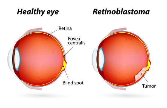 Retinoblastoma