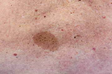 Big birthmark on woman back