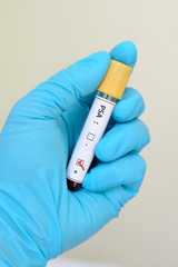 Obraz premium Blood sample with PSA (Prostate-specific antigen) positive