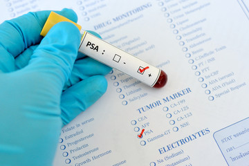 Blood sample with PSA (Prostate-specific antigen) positive