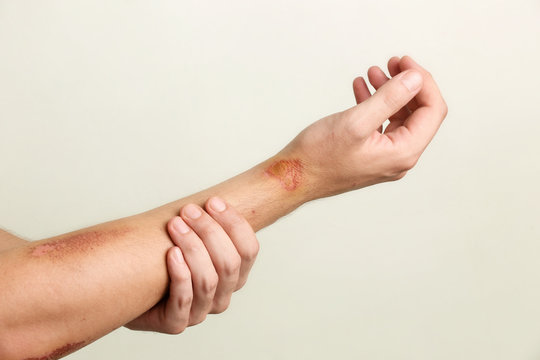 Close up view of nasty wounds on man's arm