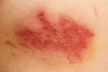 Close up view of nasty wounds 