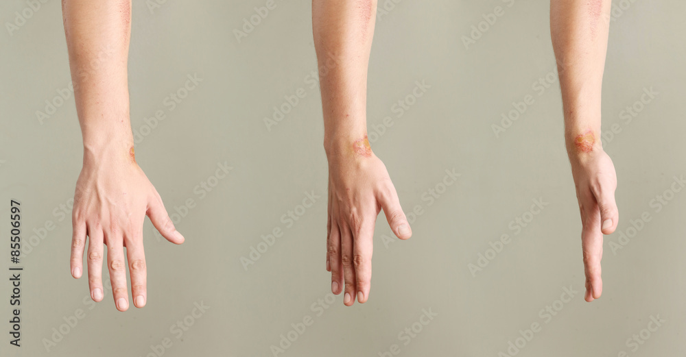 Wall mural close up view of nasty wounds on wrist from different angles