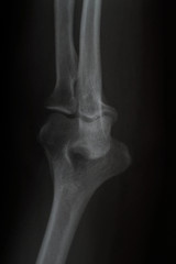 X ray picture of Elbow