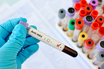 Obraz premium Hepatitis A virus (HAV) positive