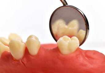 dental implant tooth