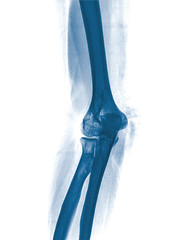 elbow x-rays ( Elbow joint Antero-posterior )on a black background