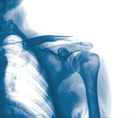 X-ray of human shoulder. front view