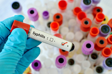 Blood sample with syphilis (Treponema Pallidum) positive