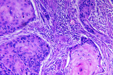 Squamous cell carcinoma of a human