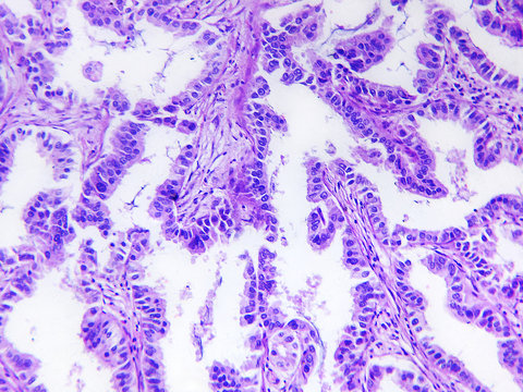 Well differentiated adenocarcinoma of a human