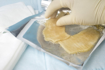 Hydrogel Burn Dressing